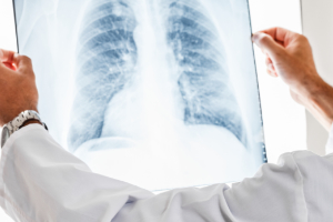 Do You Have Rib Injuries From a Motorcycle Accident?